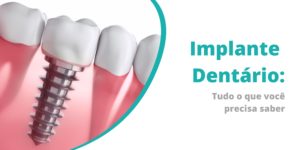 Implante Dentário jabaquara sp beneficios e riscos (2)-min