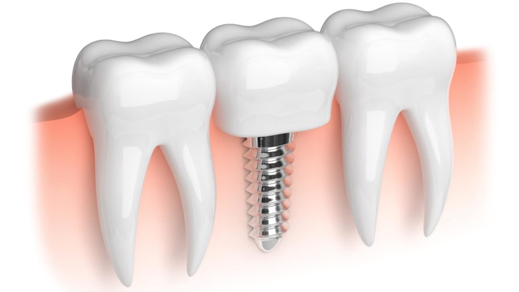 Implante-Dentario-jabaquara-sp-beneficios-e-riscos-3-min