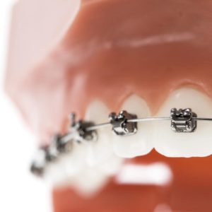 tudo por um sorriso ortodontia jabaquara aparelho metalico ceramico safira porcelana autoligado estetico 3