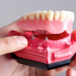 tudo por um sorriso protocolo sobre implante jabaquara protese dentaria